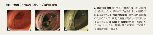 図1　大腸（上行結腸）ポリープの内視鏡像